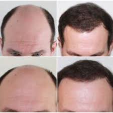 Inflammation or scarring is not usually present. Capital Hair Restoration London Hair Consultants Yell