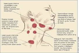 The Adult Neck Mass American Family Physician Swollen Lymph Nodes Lymph Nodes Lymph Massage