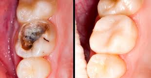 Most often, the dentist removes the decayed portion of your tooth with a drill. What Is A Cavity How To Tell If You Have One And How To Prevent Them Snapbuzzz Com