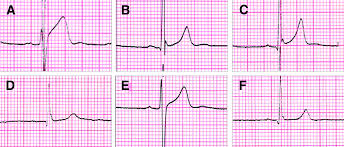 Image result for Early Repolarization