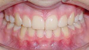 Ideale Verzahnung Kieferorthopade Lippstadt Dr Bianca Mertens