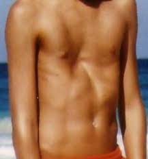 Poland syndrome is historically associated with hypoplasia of the pectoral major muscle and abnormalities of the upper limbs. Trichterbrust Diagnose Schmerzbehandlung Und Vakuumtherapie Physikalische Medizin Schmerztherapie Wien Dr Hohenstein