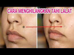Aduk sampai rata seperti pasta. Cara Menghilangkan Tahi Lalat Hilangkan Tahi Lalat Secara Alami Youtube Tahu Alam