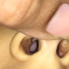 If polyps grow larger, however, you can. Asktheexperts My 4 Year Old Boy Has Nasal Polyps In His Nose What Should I Do Firstcry Parenting