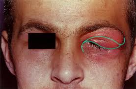 Image result for Dacryoadenitis