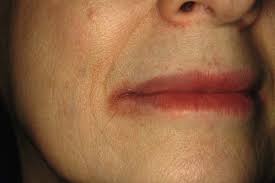 Image result for Angular Cheilitis