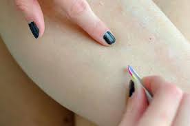 Apply a warm, moist washcloth to the area for a few minutes. Ingrown Hair On Legs Removal And Prevention