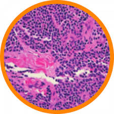 Merkel cell carcinoma (mcc) is rare and dangerous but treatable, especially when found at an early stage. Merkel Cell Carcinoma Merkel Cell Polyoma Virus Center For Emerging And Re Emerging Infectious Diseases University Of Washington