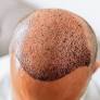 hair transplant in islamabad from ipalclinic.com