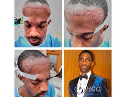 Hair transplants for black women is an option worth exploring. Afro Hair Transplant Hair Growth Centre