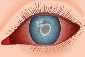 Image result for Keratitis