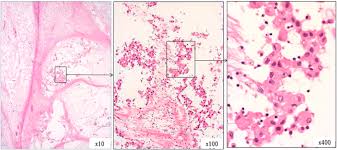 Research shows a combination of these options usually results in the most favorable life expectancy. A Patient With Epithelioid Pleural Mesothelioma Myxoid Variant Who Survived For A Long Period Without Treatment Sciencedirect