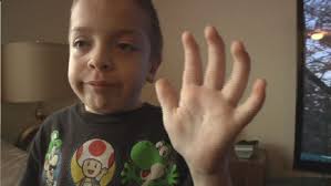 Living with Hurler Syndrome: 'All three of my boys are eventually going to  pass'