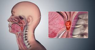 Books for people with signs and symptoms of laryngeal cancer. What Are The Symptoms Of Throat Cancer Throat Cancer Treatment