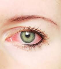 10 Proven Home Remedies For Eye Infections Natural Pink Eye Remedy Pinkeye Remedies Eye Infections