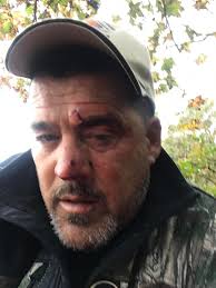 Hunter injured with black powder rifle