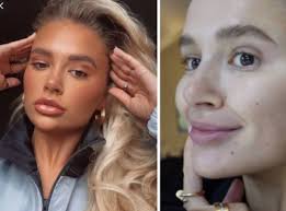 I Didn'T Know It Could Do That': Jojo Reveals Her Alarm As Lip Filler  Started To 'Migrate'
