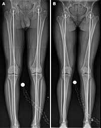 Image result for Patella Tracking Assessment