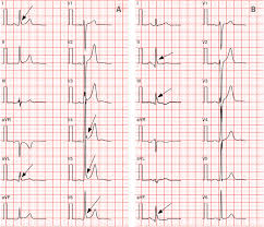 Image result for Early Repolarization