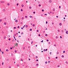 These cells malfunction and, over time, die. Niemann Pick Disease Basicmedical Key