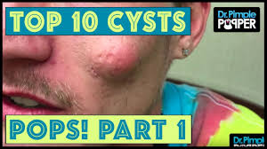Pimple popper's latest youtube video has the dermatologist removing a squishy forehead lipoma. Dr Pimple Popper S Top 10 Cyst Pops Of 2017 Part 1 Youtube