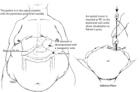 The open laparoscopy technique involves identification and incision of the peritoneum,. Https Www Ejog Org Article S0301 2115 19 30513 5 Pdf