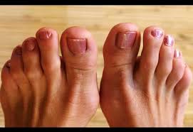 How To Get Rid Of Bunions Without Surgery Toenail Fungus Toenail Fungus Remedies Corn On Toe