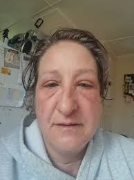 What safer medication/remedy can I use instead of this allergy medication?  I have severe inflammation