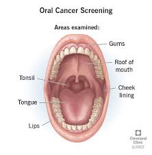 Image result for dental cancer