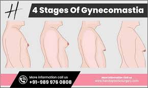 Image result for Gynecomastia