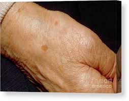 Image result for liver spots on legs