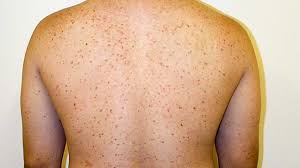 Image result for Urticaria pigmentosa children