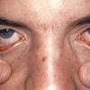The disease causes skin rashes and blistering, making the skin's top layer to shed off. 1