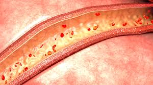 Image result for Vasculitis