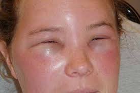 Phù Quincke là gì? Tại sao dễ nhầm lẫn với nổi mề đay?