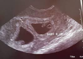 Though all signs may point to yes, you'll have to wait until you can confirm with an ultrasound after six weeks of pregnancy. 6 Weeks Pregnant With Twins Twiniversity
