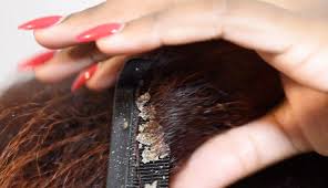 It can repair up to one year of prior hair damage. 5 Natural Ways To Treat Dry Scalp Lifeberrys Com