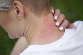 Hives, also called urticaria, are red, itchy, raised bumps or welts on the skin. Rash That Looks Like Mosquito Bites Lovetoknow