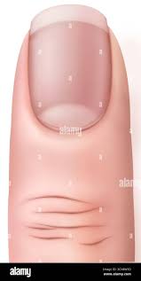 Image result for paronychium