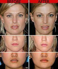 When do you see results after masseter botox injection? Jaw Injections