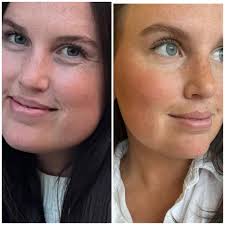 🚨 Facial slimming done with Masseter Botox ONLY! One of our favorite  treatments due to how minimally invasive it is but how impactful it can be  to your overall face shape 🩷