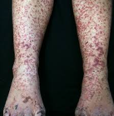 Children's paracetamol can bring down a fever. Vasculitis In Children Vasculitis Uk