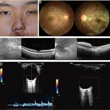 PDF) Vision-threatening complications of injection sclerotherapy: case  report, literature review, and FAERS database analysis