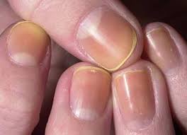 Lung disease and rheumatoid arthritis can cause yellow nails. Nail Deformities And Dystrophies Dermatologic Disorders Merck Manuals Professional Edition