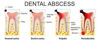 Types Of Dental Abscess Dental Check Up Dental Periodontitis