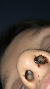 Meine nasenscheidewand ist laut meinem arzt schief, eine operation wäre erforderlich. Schmerz Nach Nasen Op Gesundheit Und Medizin Schiene