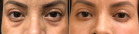 Another example of the simple circle tattoo and this one is much larger. Under Eye Dark Circles Before And After Photos New Jersey Reflections Center