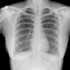 Dr andrew dixon ◉ and dr jeremy jones ◉ et al. Pdf Chest X Ray Interpretation
