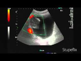 Research on personal hair dye use and the risk of bladder cancer has produced conflicting results. Color Doppler Ultrasound Bladder Cancer Youtube