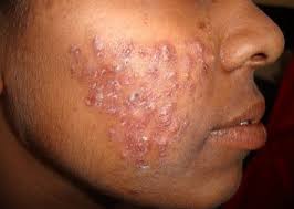 Image result for acne face